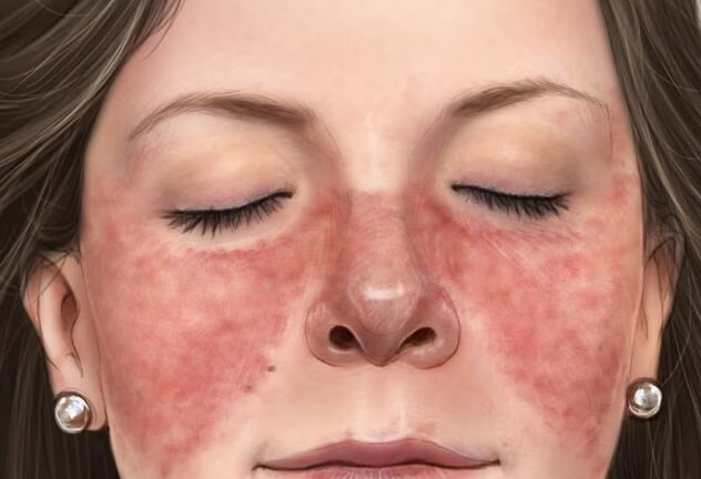 Mengenal Penyebab dari Timbulnya Penyakit Lupus